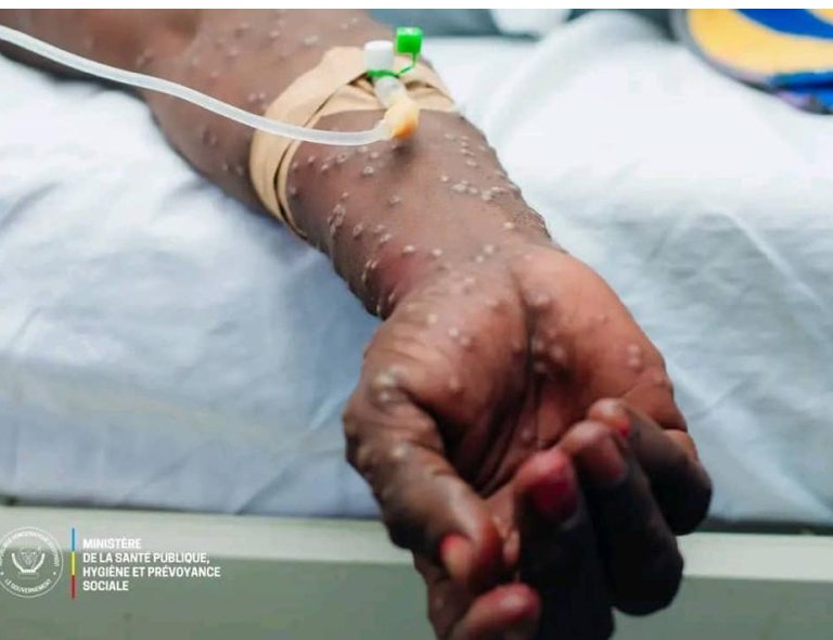 Mpox en RDC : une augmentation des cas suspects de 478 à 893 et une hausse de la létalité de 0,21 % à 1 %, note le gouvernement