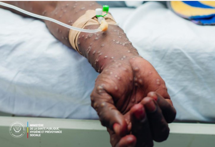 Ituri : 3 cas confirmés et 21 cas suspects de Mpox enregistrés à Mambasa