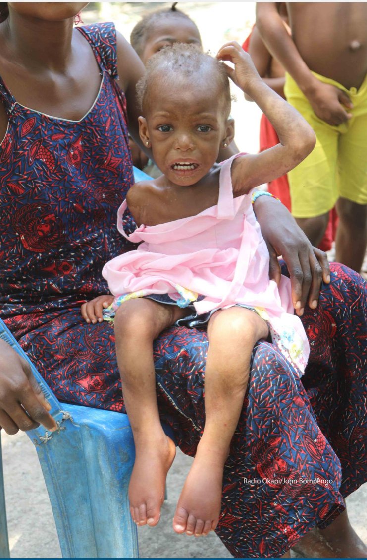 La malnutrition des enfants dans la province du Haut-Uélé.